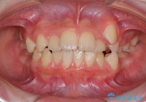 乳歯が残っている　目立たない装置での抜歯矯正の症例 治療前