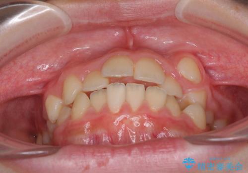 乳歯が残っている 目立たない装置での抜歯矯正の治療前