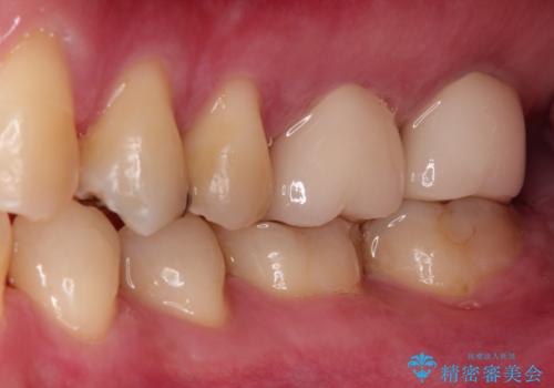 目立つ金歯を自然な色のオールセラミックへの治療後
