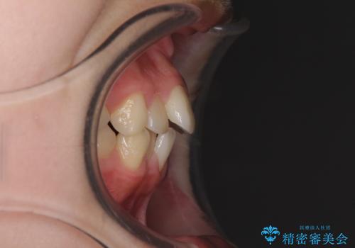 乳歯が残っている 目立たない装置での抜歯矯正の治療前