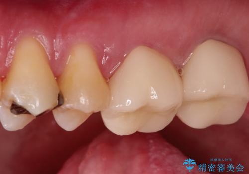 目立つ金歯を自然な色のオールセラミックへの治療後