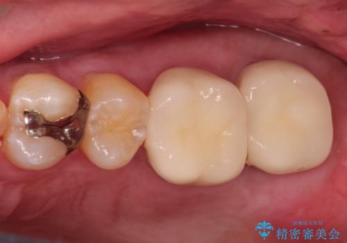 目立つ金歯を自然な色のオールセラミックへの治療後