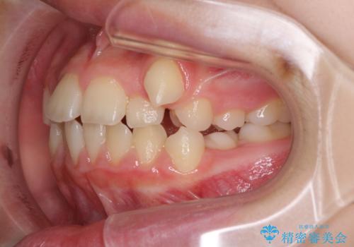 乳歯が残っている 目立たない装置での抜歯矯正の治療前