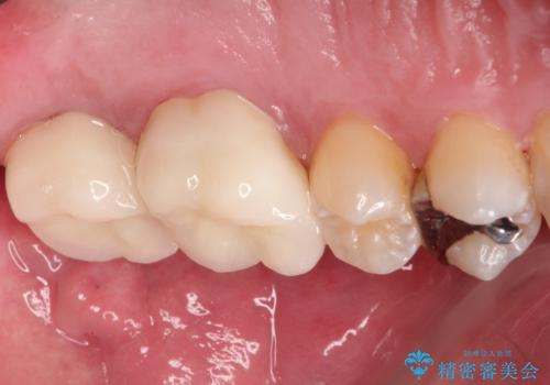 目立つ金歯を自然な色のオールセラミックへの治療後