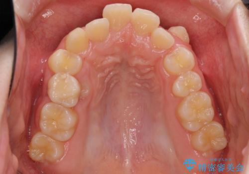 乳歯が残っている 目立たない装置での抜歯矯正の治療前