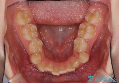 乳歯が残っている 目立たない装置での抜歯矯正の治療前