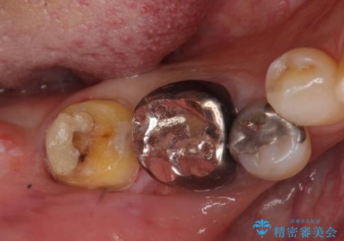 下の奥歯の虫歯　歯周外科手術を含めた治療の治療中
