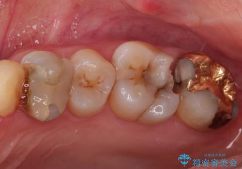 他院による虫歯治療(ドックスベストセメント)の再治療の治療前