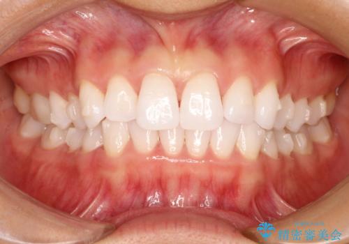 気になる前歯の歯並びをインビザラインで矯正の治療中