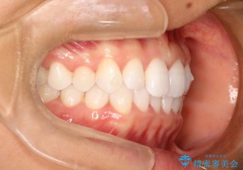 気になる前歯の歯並びをインビザラインで矯正の治療中
