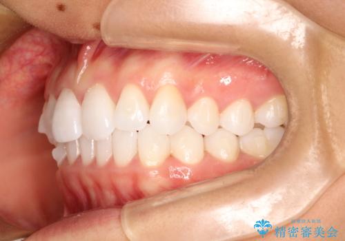 気になる前歯の歯並びをインビザラインで矯正の治療中