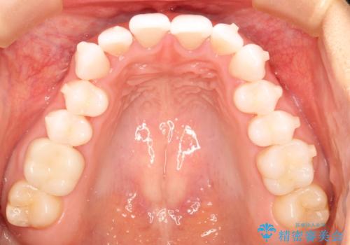 気になる前歯の歯並びをインビザラインで矯正の治療中