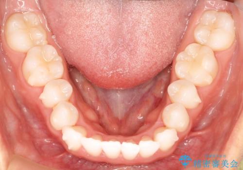気になる前歯の歯並びをインビザラインで矯正の治療中