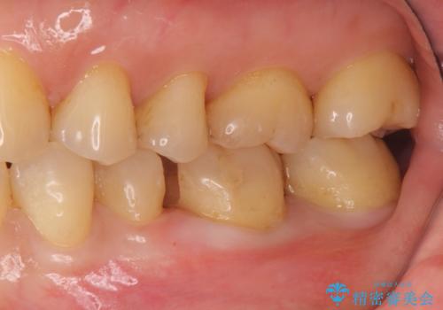 目立つ銀歯を全て白く　セラミックで虫歯治療の治療中