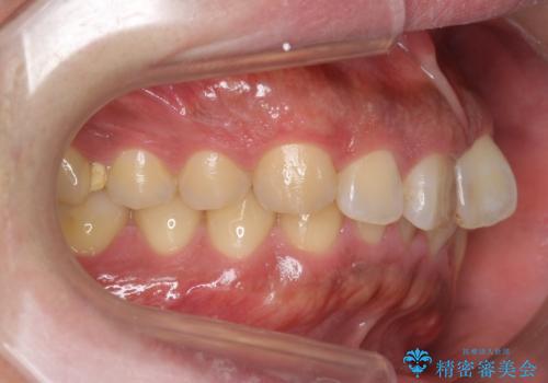 前歯のねじれを 1年かけずに矯正 インビザラインの治療前