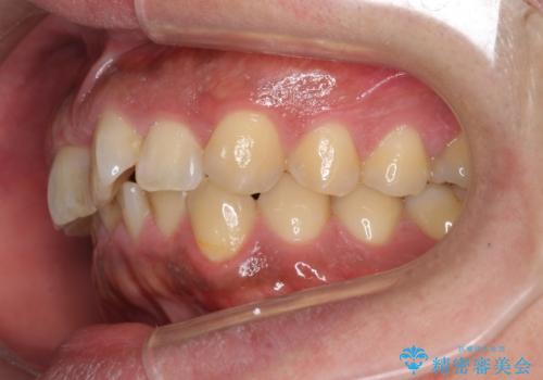 前歯のねじれを 1年かけずに矯正 インビザラインの治療前