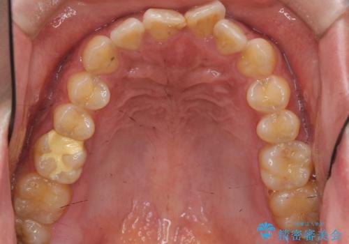 前歯のねじれを 1年かけずに矯正 インビザラインの治療前