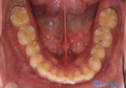 前歯のねじれを 1年かけずに矯正 インビザラインの治療前