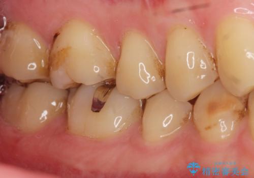 深い虫歯 丁寧にう蝕を除去し神経を保存 30代男性の治療前