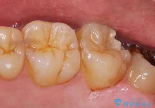 深い虫歯　丁寧にう蝕を除去し神経を保存　30代男性の治療前