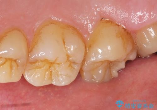 深い虫歯 丁寧にう蝕を除去し神経を保存 30代男性の治療前