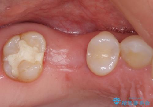 抜歯になった虫歯 奥歯のインプラント治療の治療中