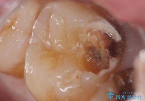 深い虫歯 丁寧にう蝕を除去し神経を保存 30代男性の治療前