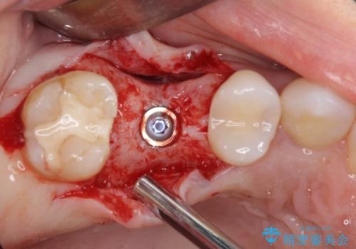 抜歯になった虫歯 奥歯のインプラント治療の治療後
