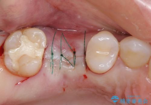 抜歯になった虫歯 奥歯のインプラント治療の治療前
