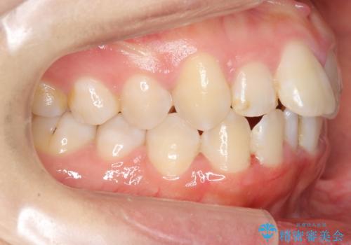 上下の前歯のがたつき 歯を抜かずに矯正の治療前