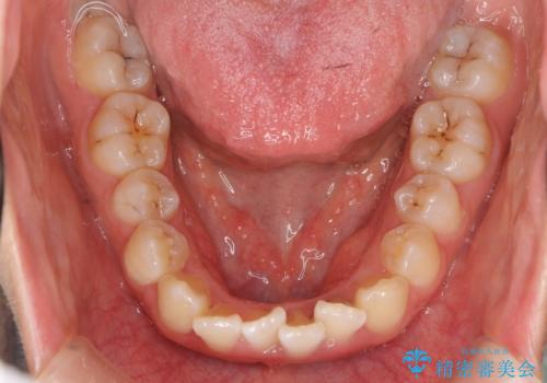 上下の前歯のがたつき 歯を抜かずに矯正の治療前