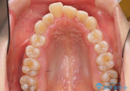 上下の前歯のがたつき 歯を抜かずに矯正の治療前