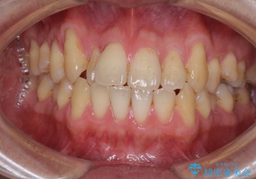 矯正歯科治療と前歯の歯肉移植術の症例 治療前