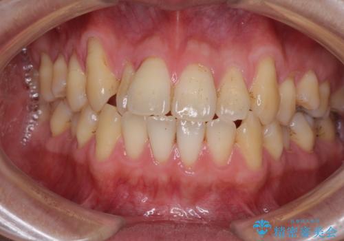 矯正歯科治療と前歯の歯肉移植術の治療前