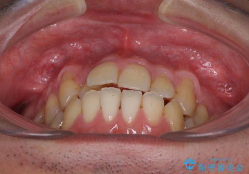 矯正歯科治療と前歯の歯肉移植術の治療前