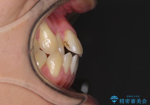 矯正歯科治療と前歯の歯肉移植術の治療前