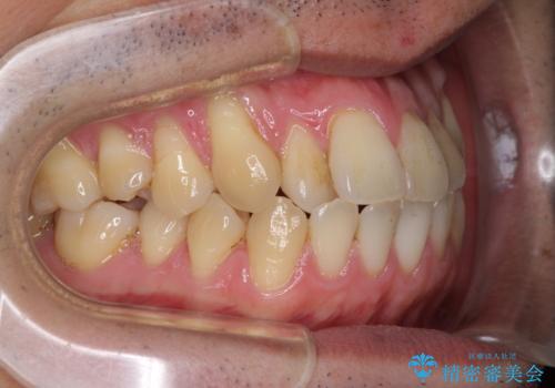 矯正歯科治療と前歯の歯肉移植術の治療前