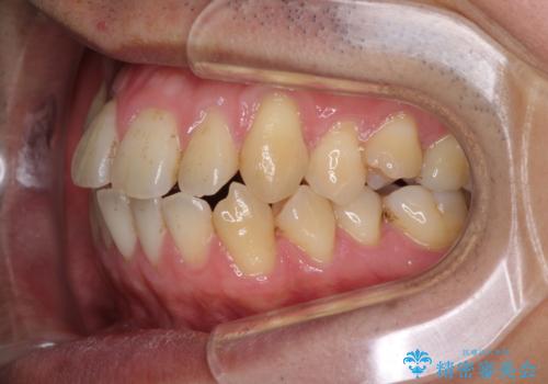 矯正歯科治療と前歯の歯肉移植術の治療前
