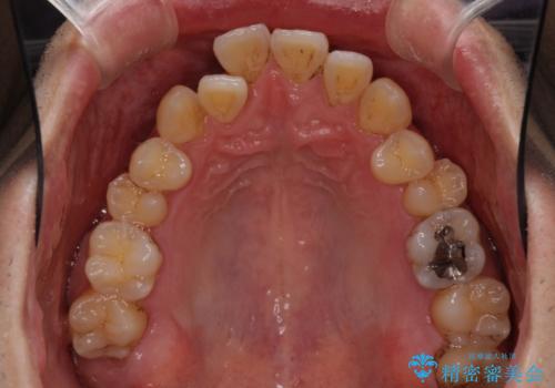 矯正歯科治療と前歯の歯肉移植術の治療前