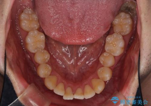 矯正歯科治療と前歯の歯肉移植術の治療前