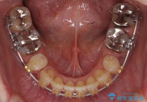 40代の矯正 出っ歯、歯のがたがたの治療中