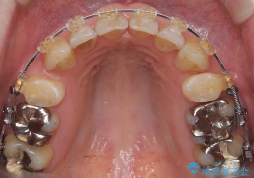 40代の矯正 出っ歯、歯のがたがたの治療中
