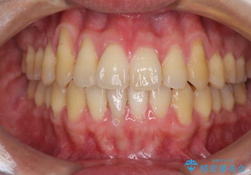矯正歯科治療と前歯の歯肉移植術の治療前