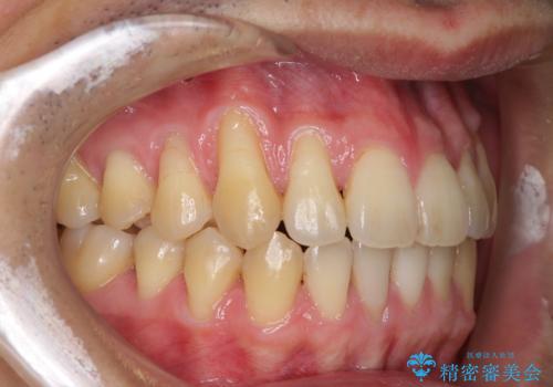 矯正歯科治療と前歯の歯肉移植術の治療前