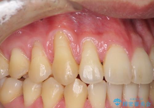 矯正歯科治療と前歯の歯肉移植術の治療前