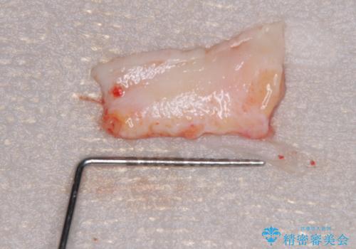 矯正歯科治療と前歯の歯肉移植術の治療前