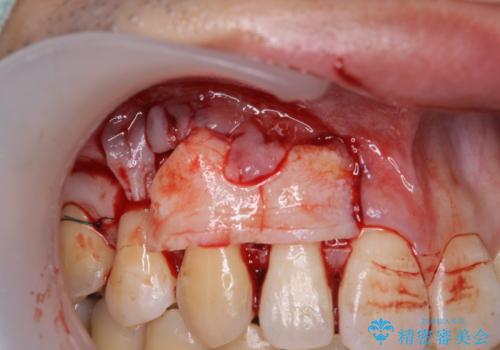 矯正歯科治療と前歯の歯肉移植術の治療中