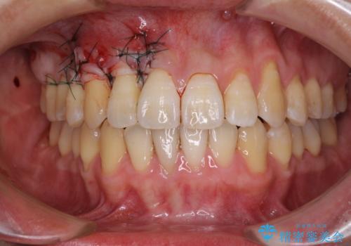 矯正歯科治療と前歯の歯肉移植術の治療中