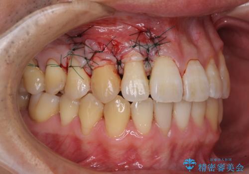 矯正歯科治療と前歯の歯肉移植術の治療中