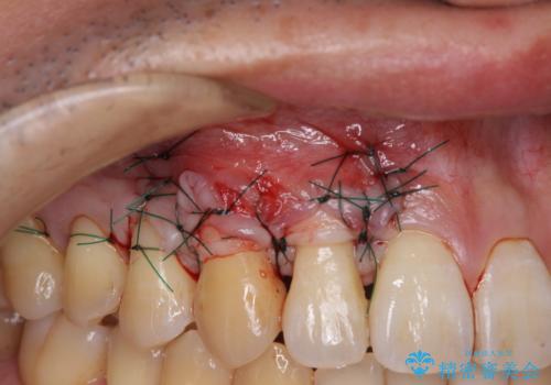 矯正歯科治療と前歯の歯肉移植術の治療中
